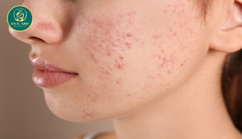 5 lầm tưởng về mụn trứng cá và chế độ ăn uống giảm mụn 1